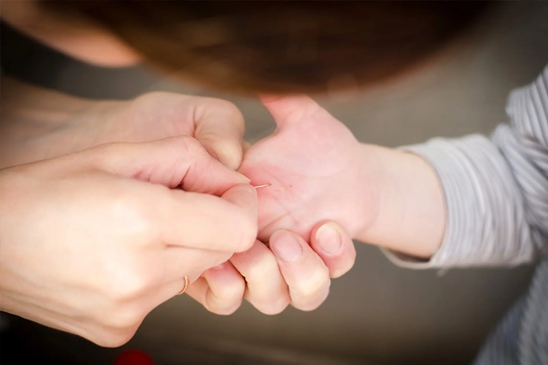 Làm gì khi bị dằm đâm vào tay? Mách bạn 9 mẹo lấy dằm ra khỏi tay không phải ai cũng biết