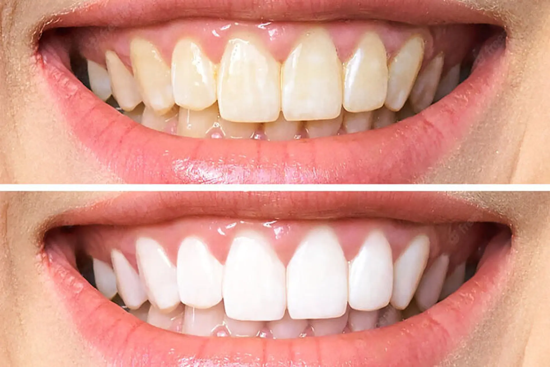 Tổng hợp những cách làm trắng răng tại nhà đơn giản, an toàn từ những nguyên liệu có sẵn