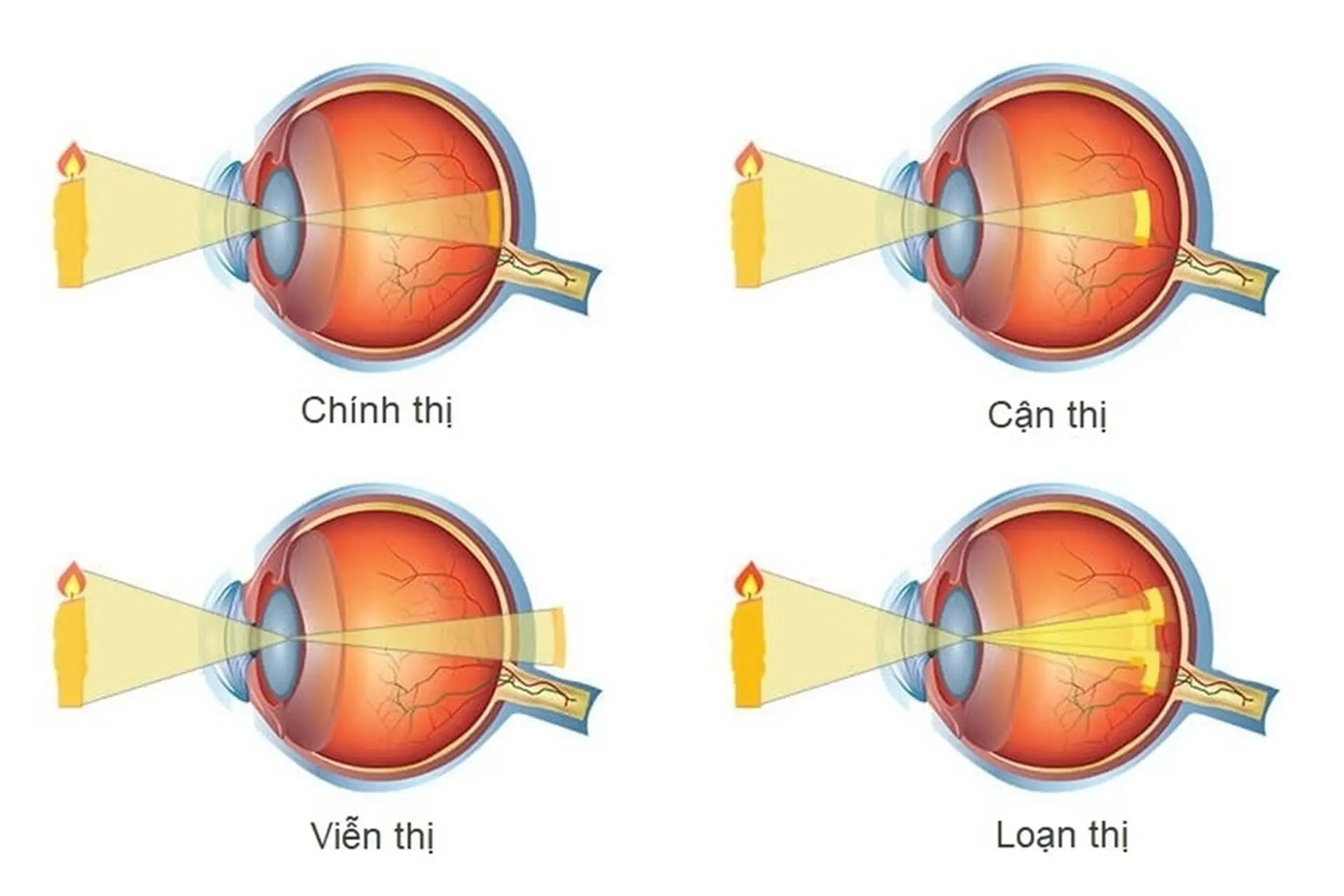 Mắt chính thị là gì? Dấu hiệu, khả năng nhìn và những khác biệt so với các tật khúc xạ
