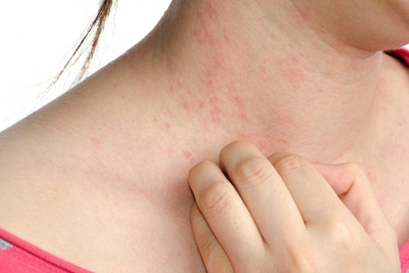 Dị ứng khi ăn hành tây