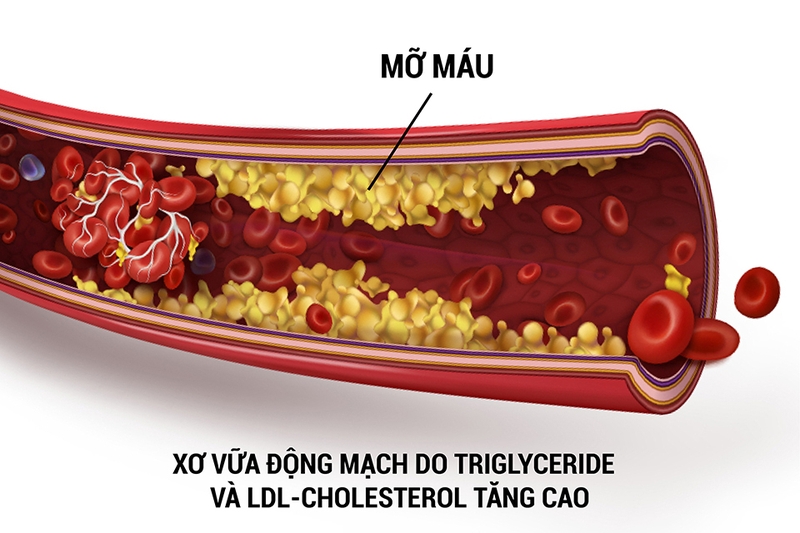 Tác hại nghiêm trọng của triglyceride cao đối với sức khỏe