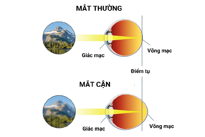 Ý nghĩa của diop trong nhãn khoa