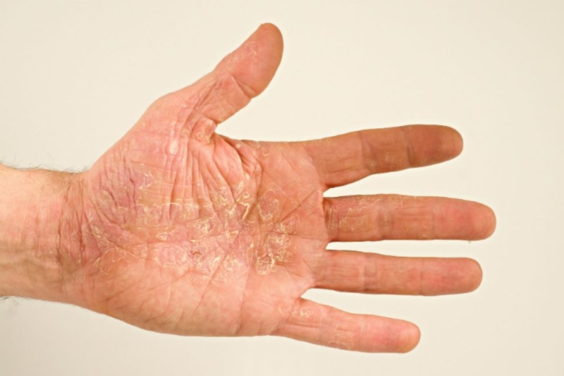 Chữa bệnh tổ đỉa