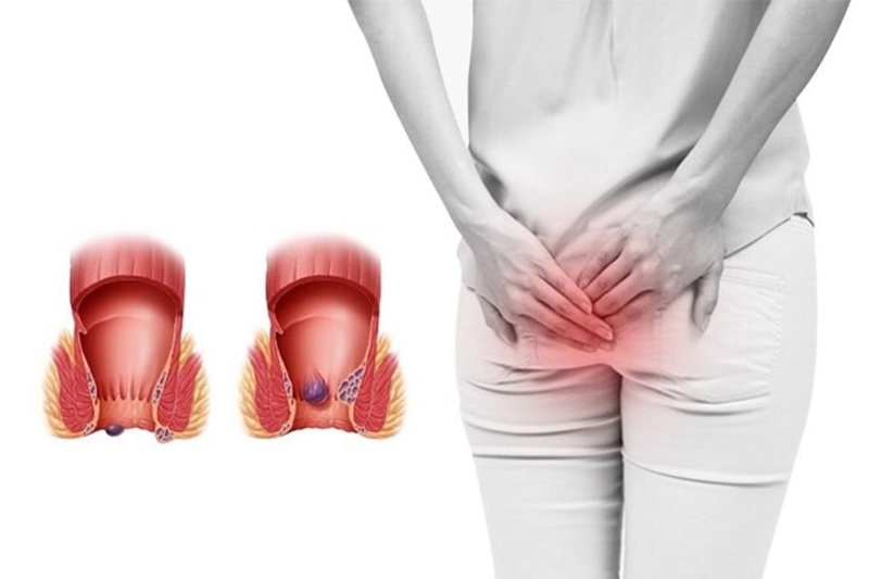 Chữa bệnh trĩ bằng phương pháp xông hơi