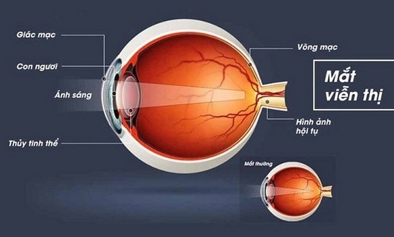 mắt chính thị là gì ảnh 3