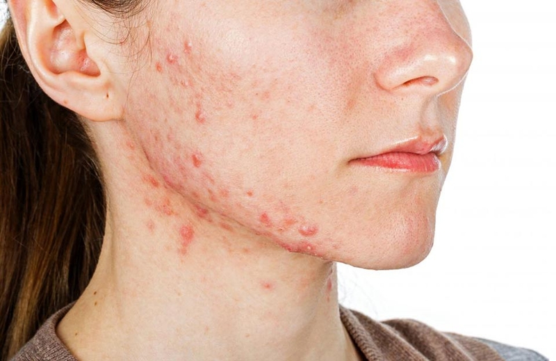 Nước ép trị mụn nội tiết - 07