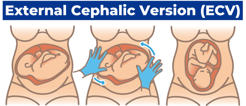 External Cephalic Version