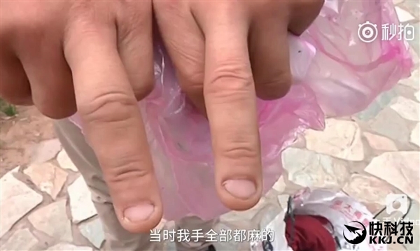 iPhone 7 bất ngờ nổ khi đang quay video làm bị thương một người đàn ông iPhone 7 bất ngờ nổ khi đang quay video làm bị thương một người đàn ông