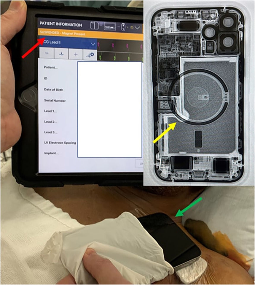 Phụ kiện MagSafe và iPhone 12 có thể gây nhiễu cho điều hoà nhịp tim và máy khử rung (ảnh 2) Phụ kiện MagSafe và iPhone 12 có thể gây nhiễu cho điều hoà nhịp tim và máy khử rung (ảnh 2)