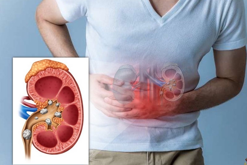 Vì sao nước đun sôi có cặn trắng (Ảnh 3)