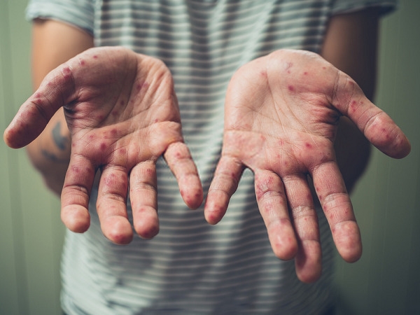 Nước nhiễm sắt gây ra nhiều tác hại đe dọa sức khỏe con người
