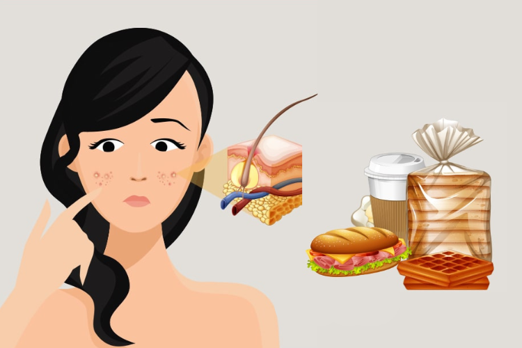 Carbohydrate trong bánh mì dễ gây nổi mụn nếu ăn nhiều