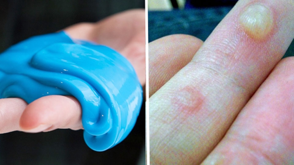 Slime có thể gây ra các bệnh về da nghiêm trọng