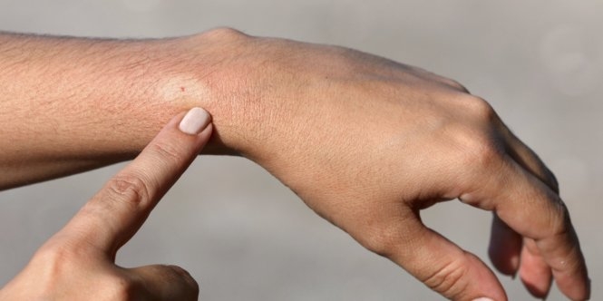 Cách chữa ong đốt hết sưng nhanh nhất là gì? Những điều cần lưu ý khi bị ong đốt 1