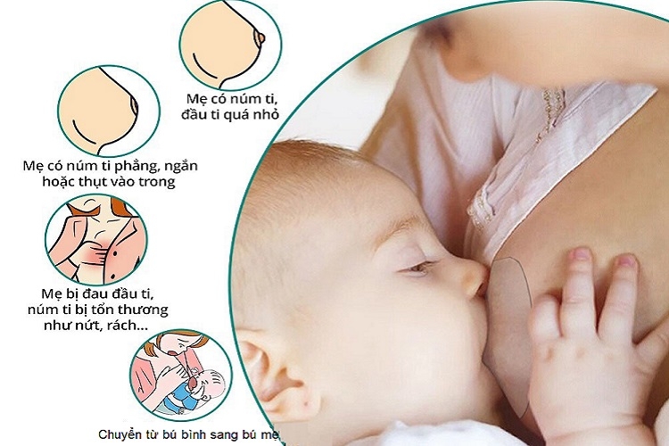 Những trường hợp mẹ nên dùng núm trợ ti