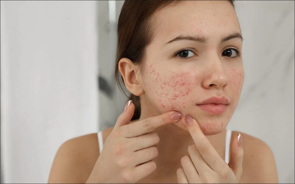 Ăn quả vả giúp ngăn ngừa mụn trứng cá