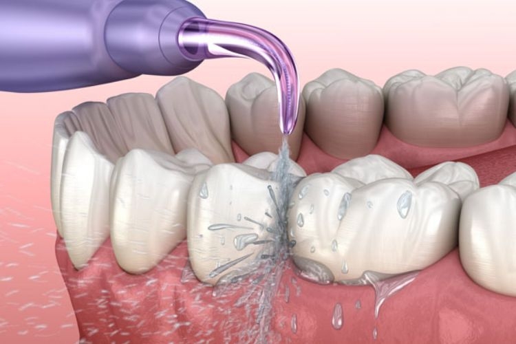 Tại sao nên sử dụng tăm nước?