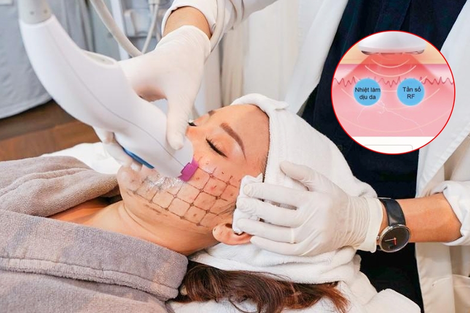 Công nghệ RF hay còn được gọi là điều trị tần số vô tuyến.