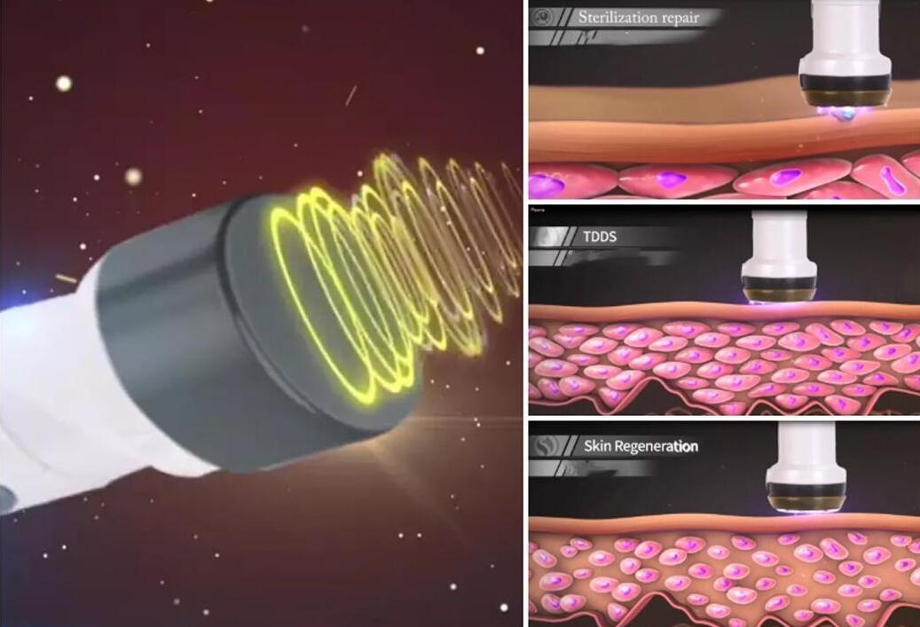 Công nghệ sóng âm T-sonic có khả năng khả năng thâm nhập qua các lớp bề mặt của da, giúp làm sạch và trẻ hóa