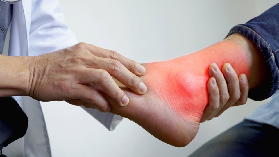 Người bị gout không nên ăn gạch cua