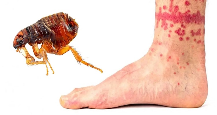 Bọ chét cắn gây phồng rộp, lở loét, ngứa rát