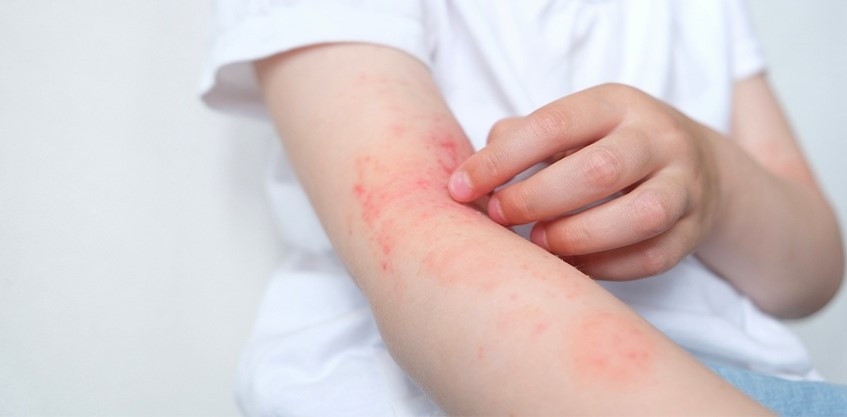 Tác hại của nước nhiễm phèn đối với làn da