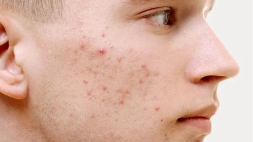 Thúc đẩy mụn trứng cá phát triển