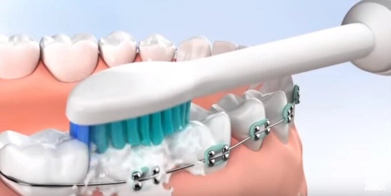 niềng răng có nên dùng bàn chải điện không? 8