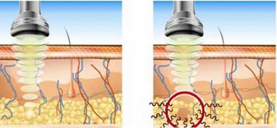 Tác động của sóng siêu âm đến mô cơ thể