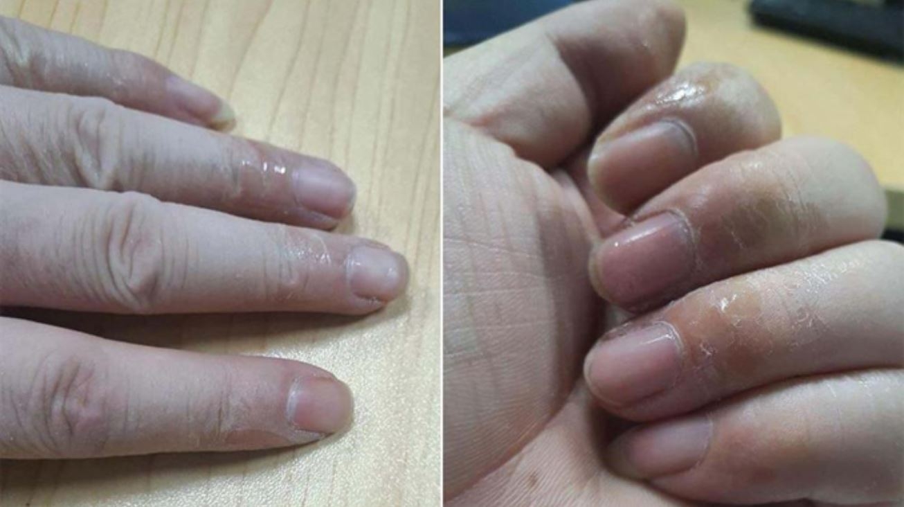 Cách tẩy keo dính trên da (ảnh 5)