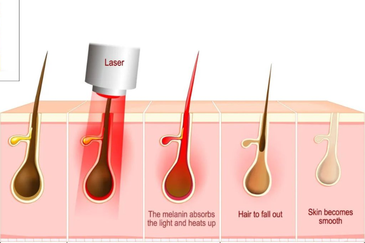 Xung máy triệt lông là gì 2