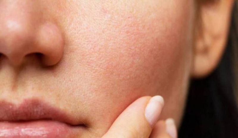 Hỗ trợ làm dịu da cháy nắng