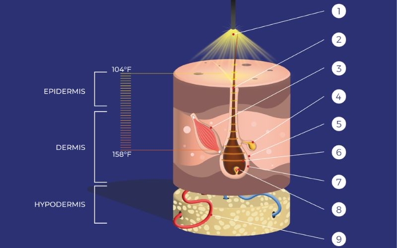 Công nghệ IPL là gì