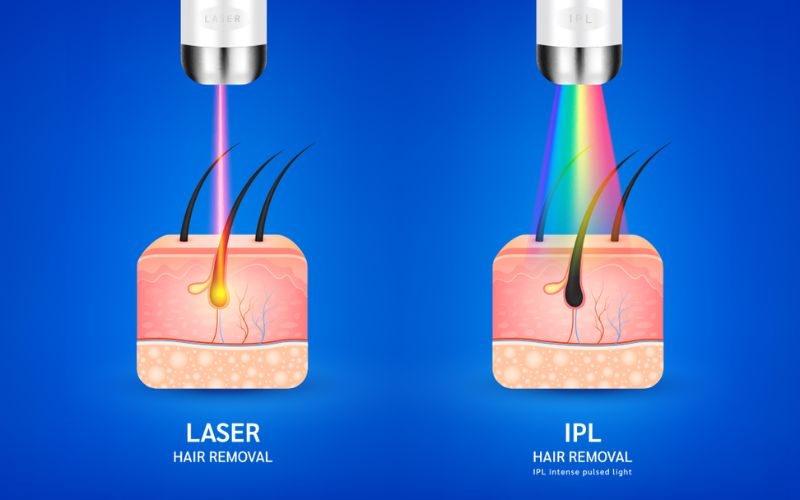Công nghệ IPL hoạt động như thế nào