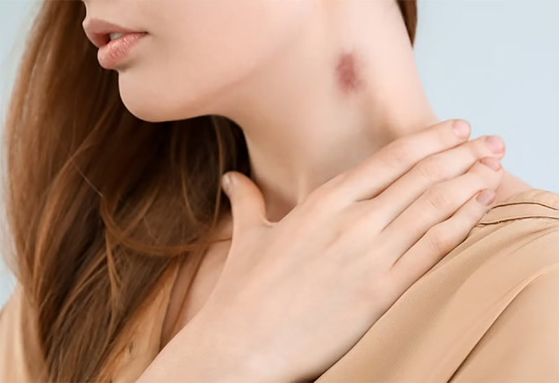 dấu hickey (hình 4)