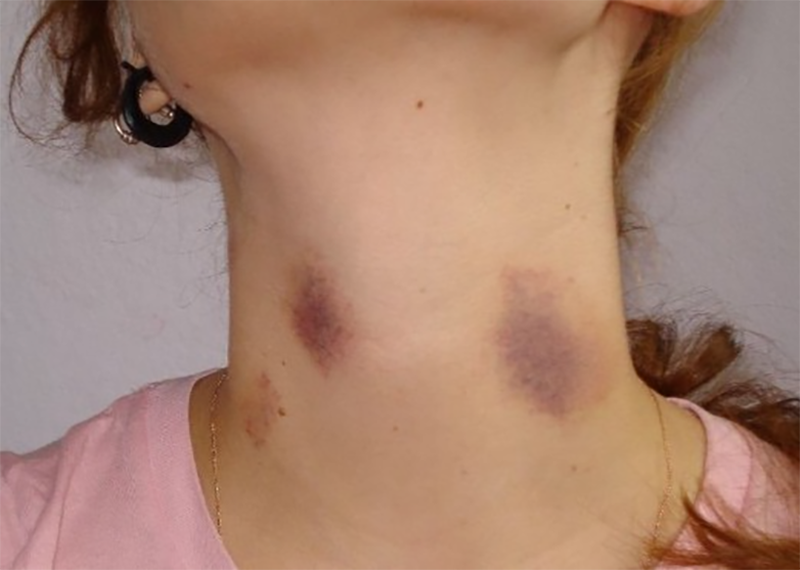 dấu hickey (hình 7)